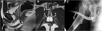 Case Report: Bilateral syringocele in an adolescent—area of focus